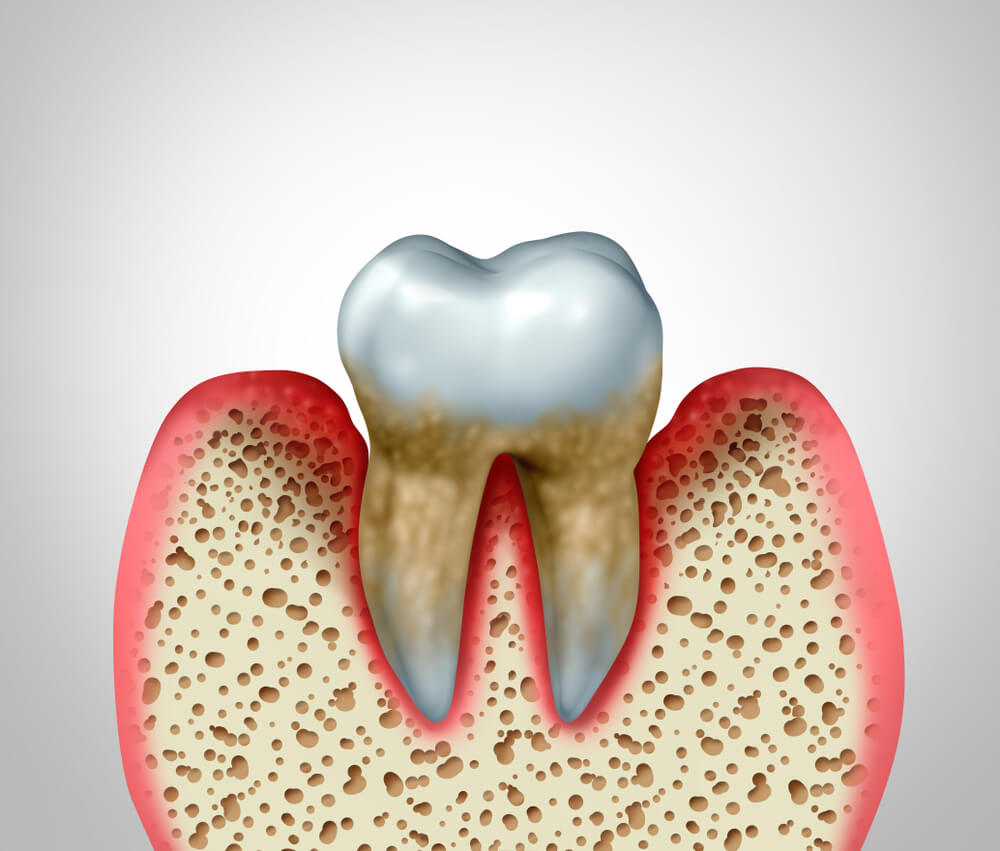 root canal cost in Mira Road