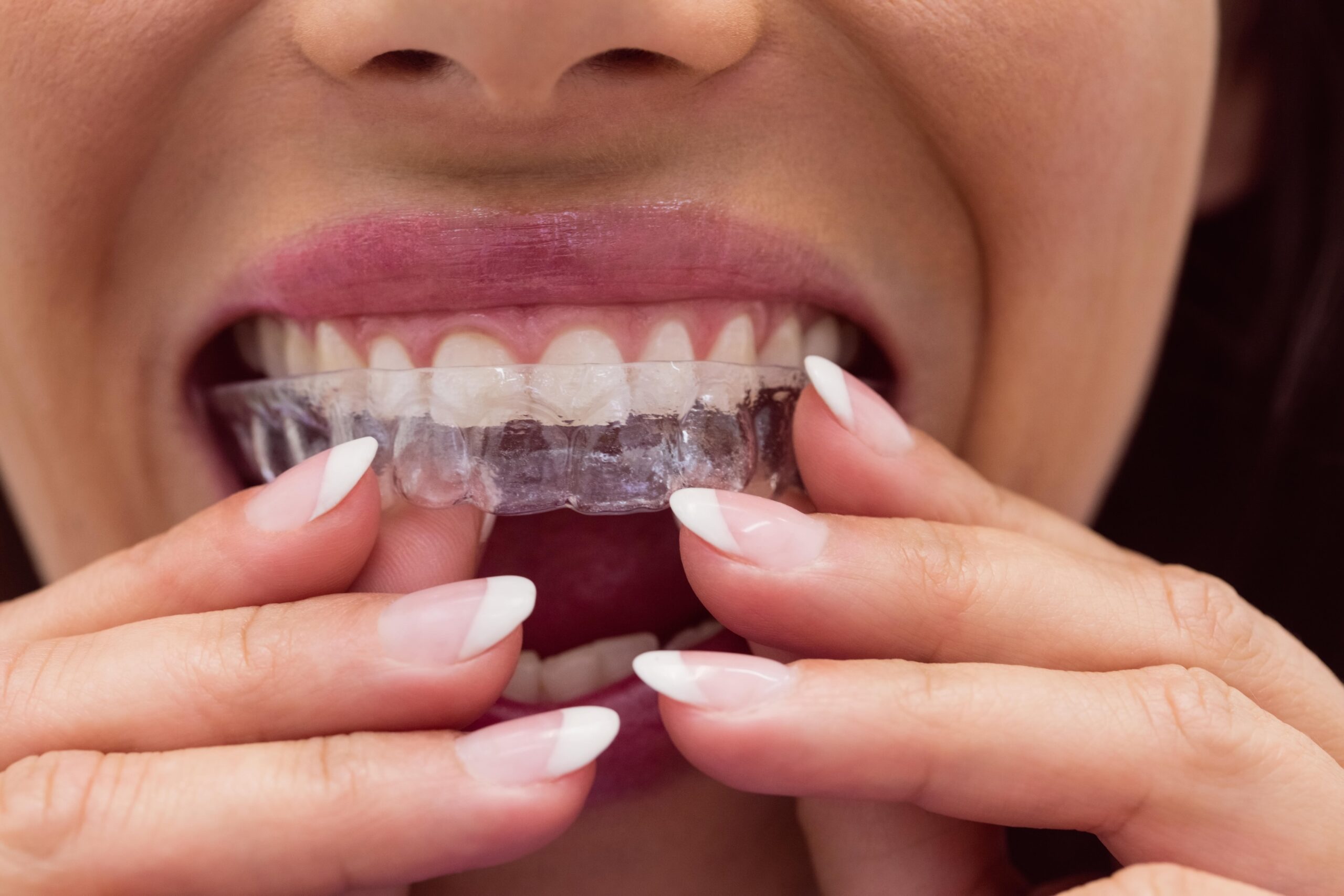 orthodontist in Mira Bhayandar for braces