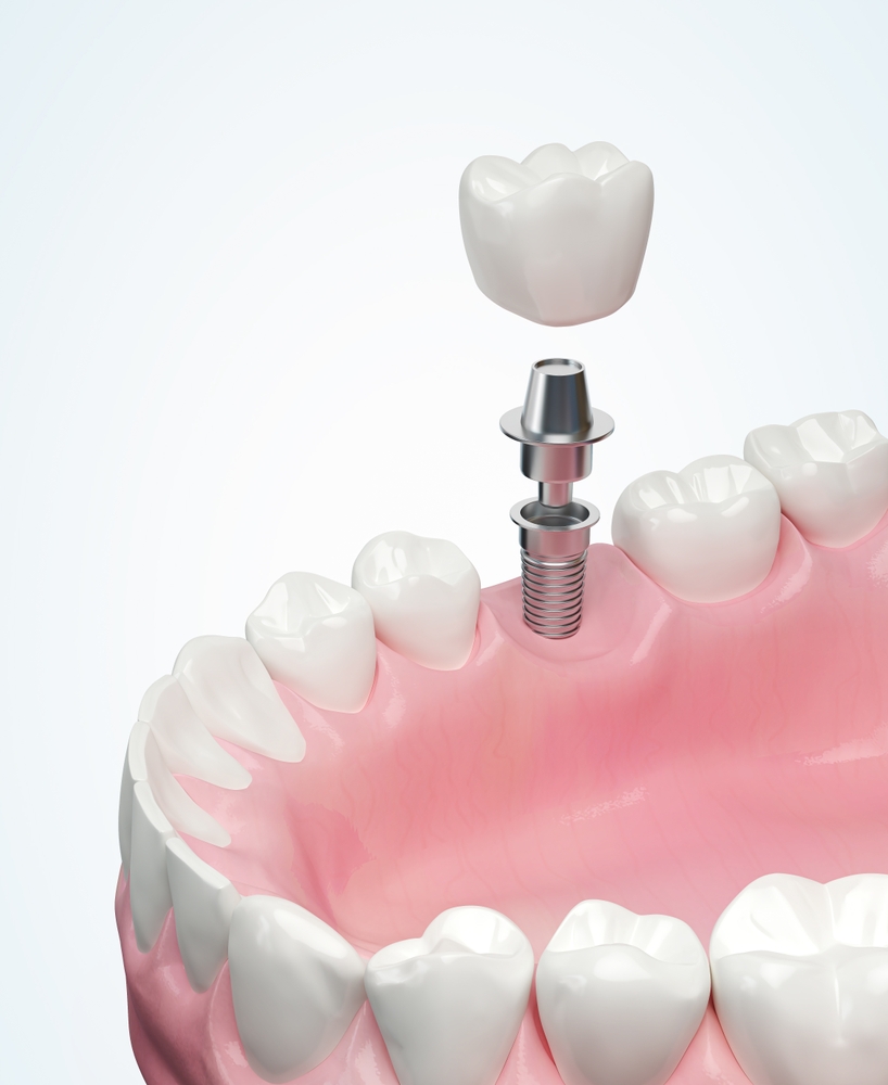 dental implant specialists in Mira Bhayandar