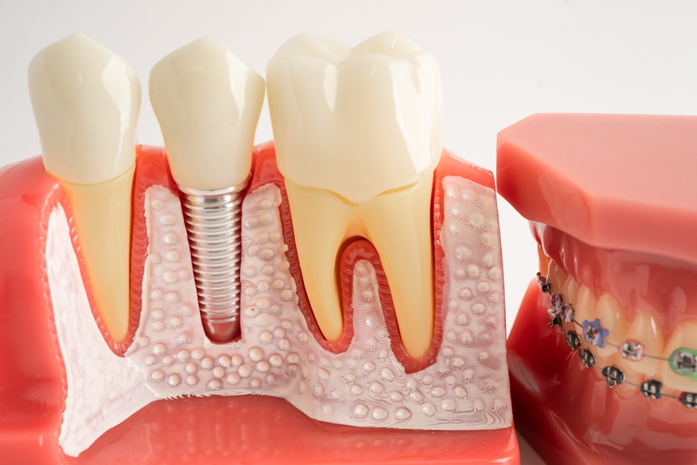 Dental Implant Specialists in Mira Bhayandar