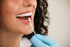 Ceramic Veneers in Mira Bhayandar
