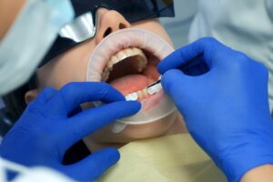 Ceramic veneers in mira bhayandar