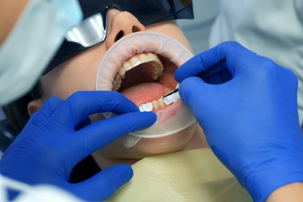 Ceramic veneers in mira bhayandar