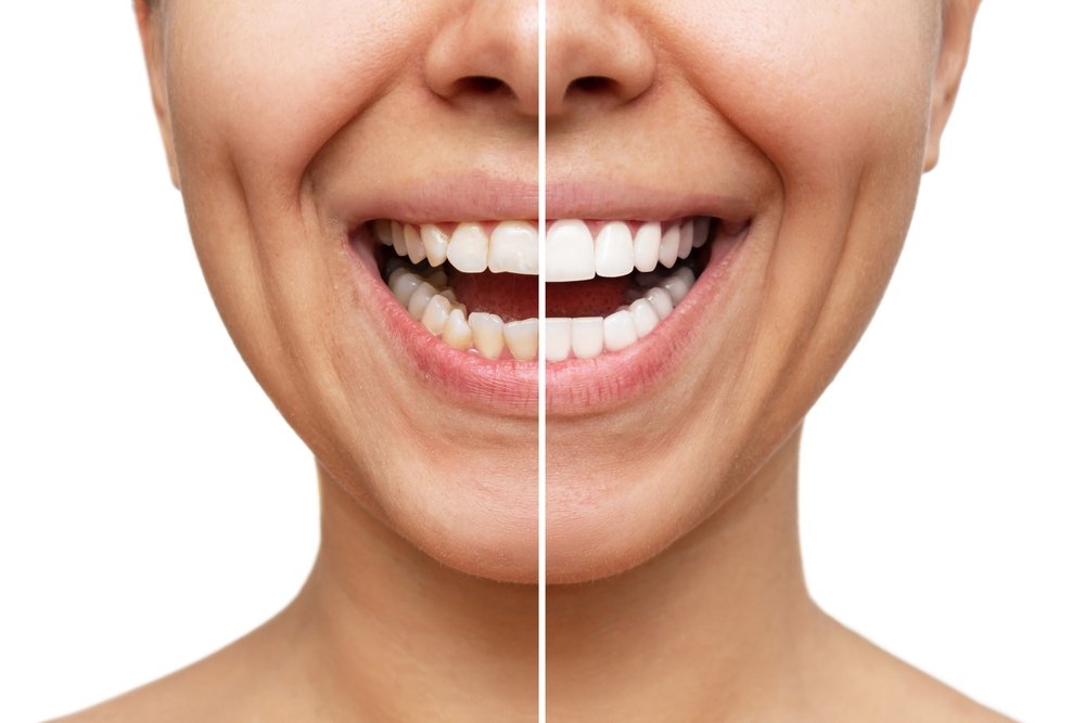 Dramatically Enhance Your Smile